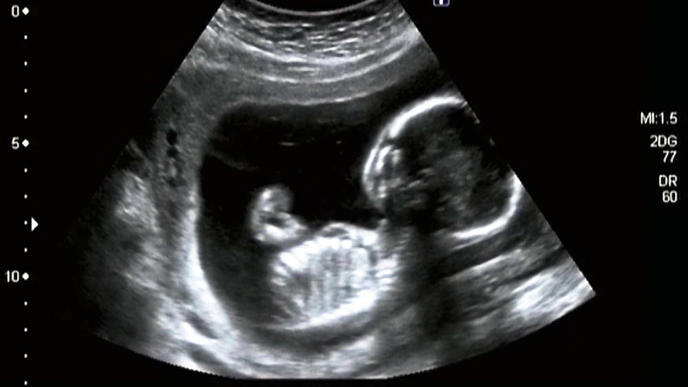 Ultraschallbild eines Embryos (Symbolbild)