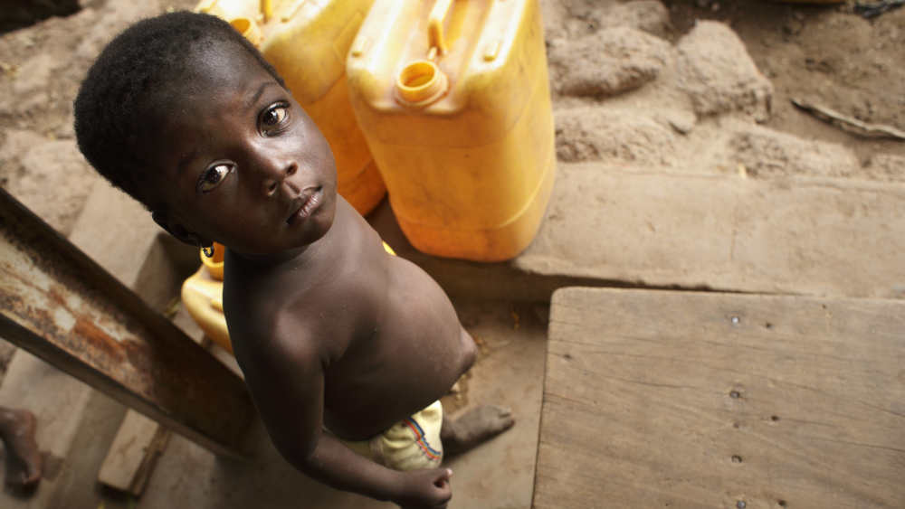 Kind mit Hungeroedem: Millionen Afrikaner kämpften angesichts knapper Wasserquellen, Hunger und Konflikten ums Überleben