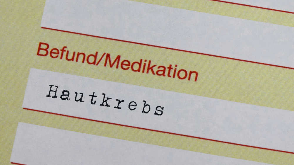 Hautkrebs wird seit 20 Jahren immer häufiger diagnostiziert