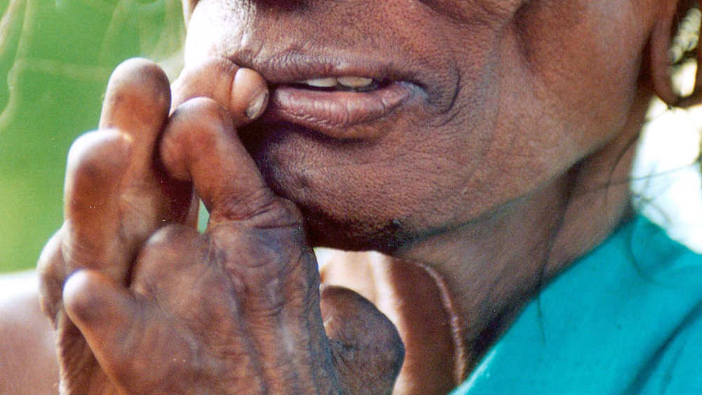 Eine von Lepra gezeichnete Frau in Indien: Rund 200.000 Menschen erkranken noch immer jedes Jahr an Lepra