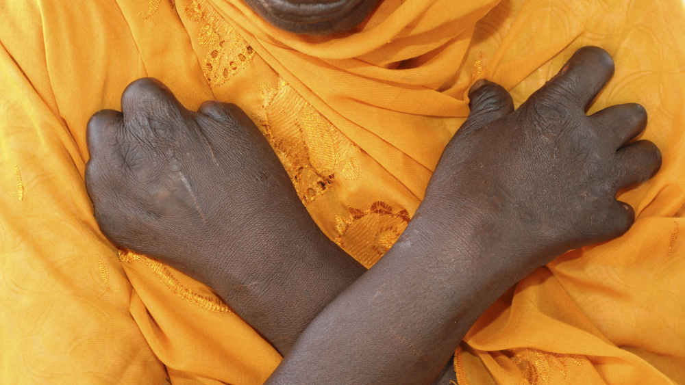 Image - Täglich infizieren sich Menschen mit Lepra